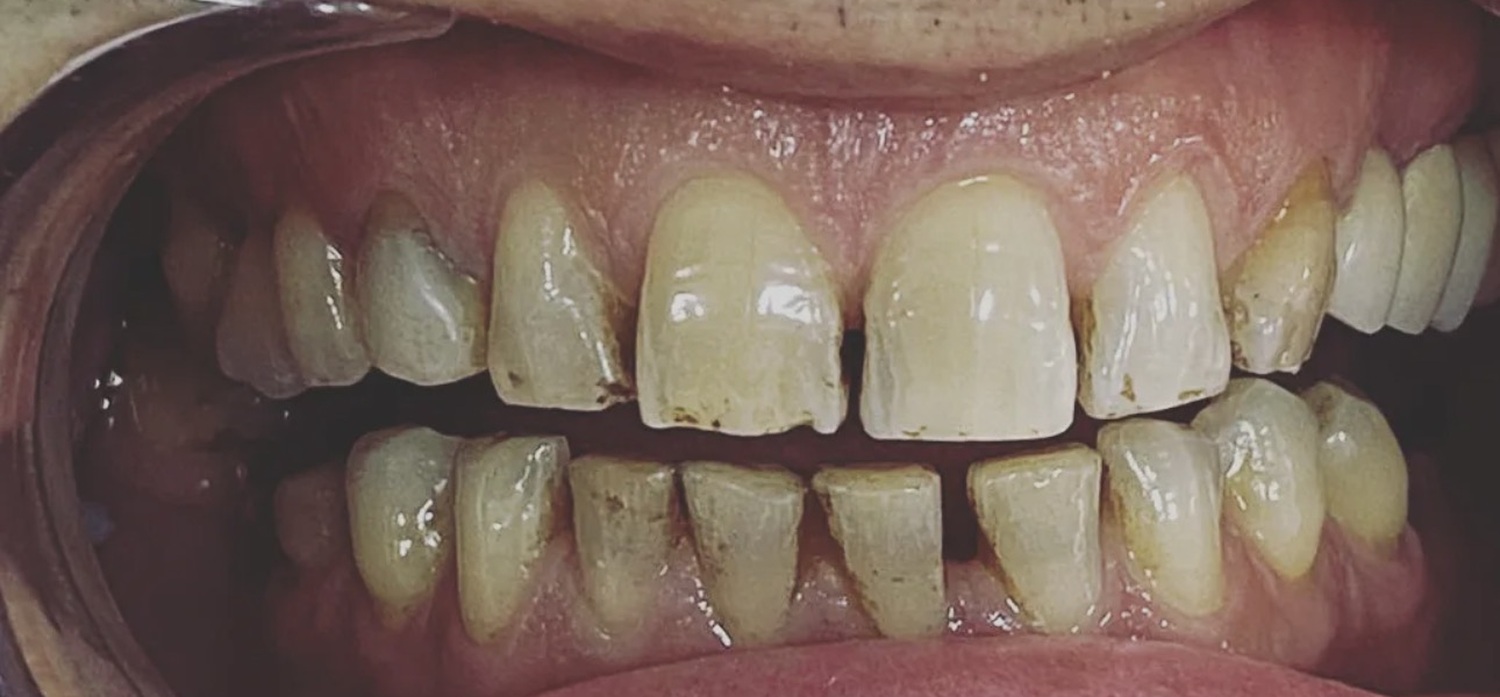 Before treatment at İ-Klinik