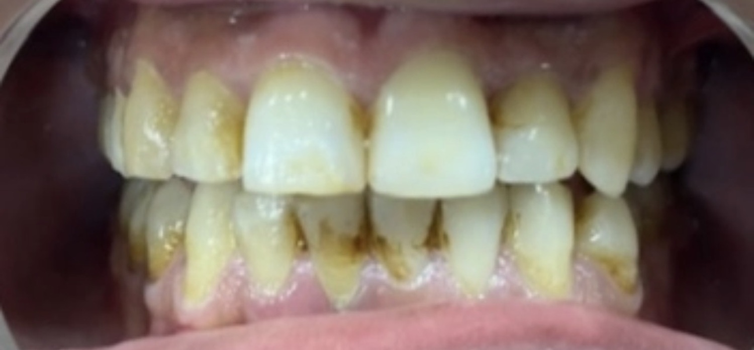 Before treatment at İ-Klinik