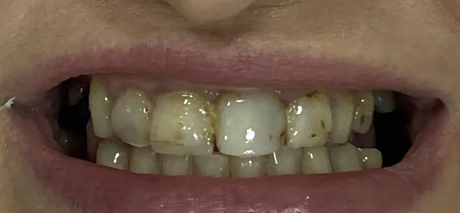 Before treatment at İ-Klinik