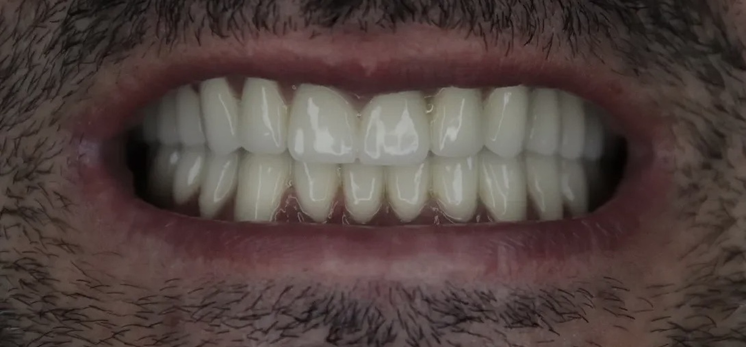 After treatment at İ-Klinik