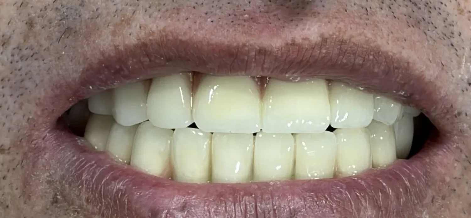 After treatment at İ-Klinik
