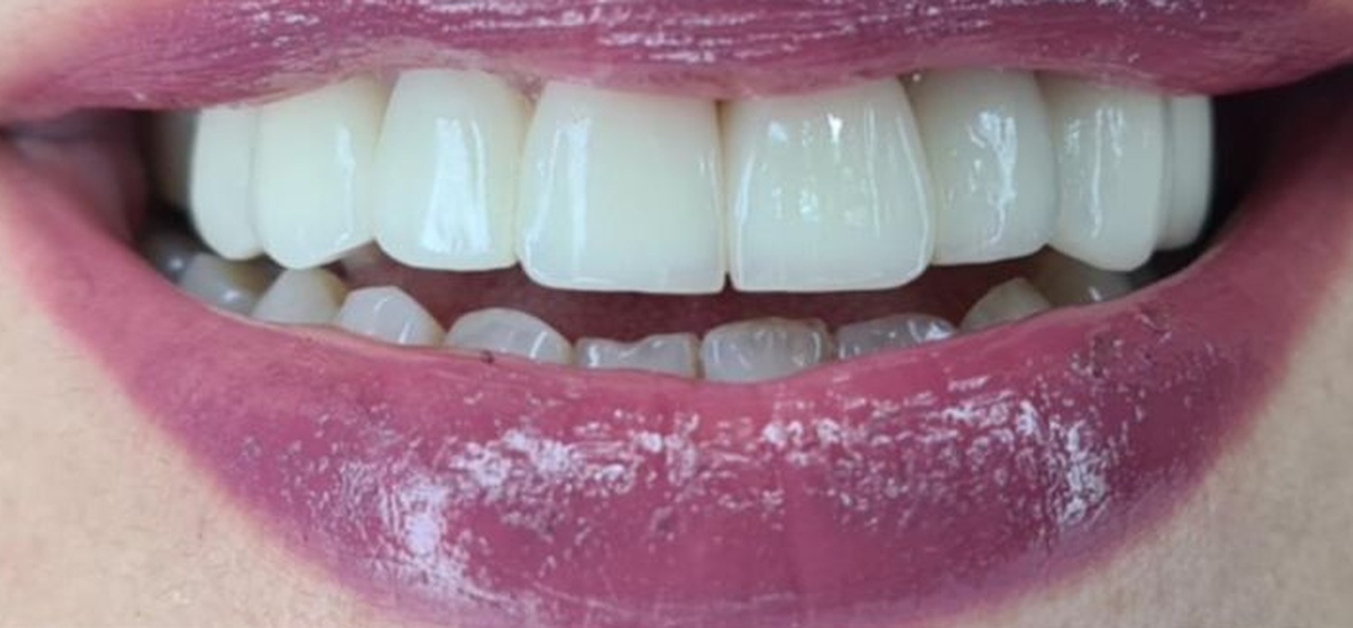 After treatment at İ-Klinik
