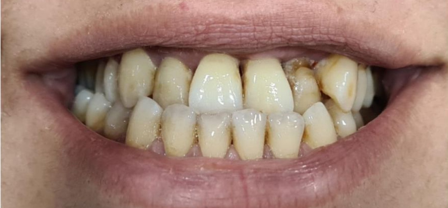 Before treatment at İ-Klinik