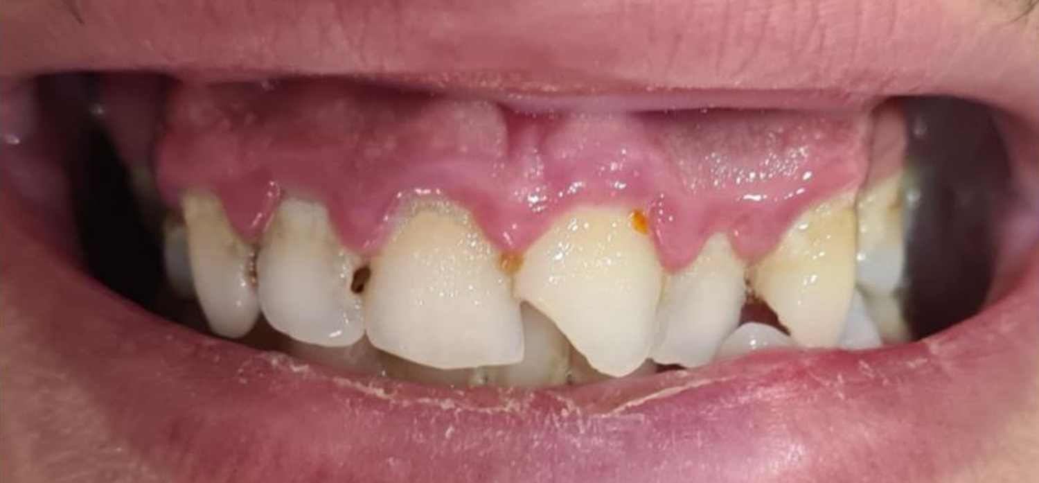 Before treatment at İ-Klinik