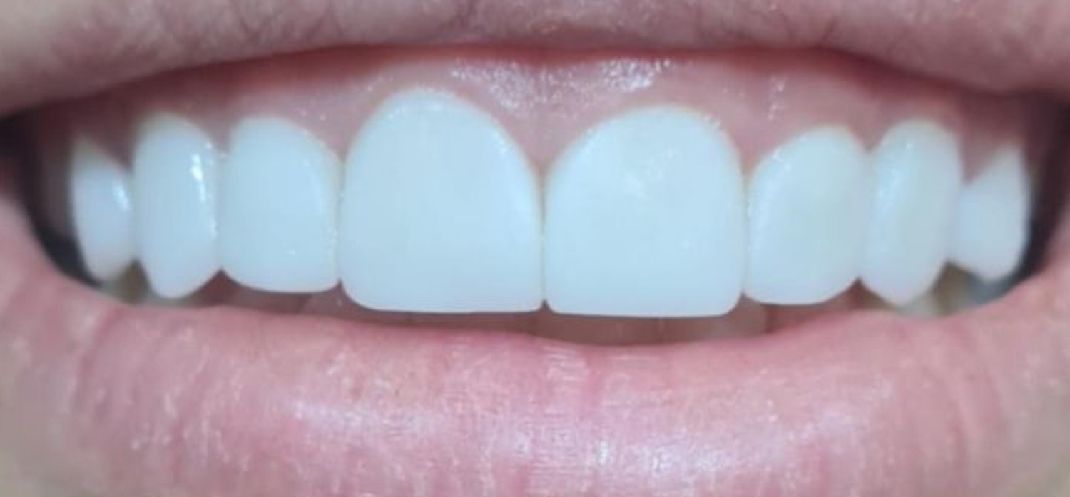 After treatment at İ-Klinik