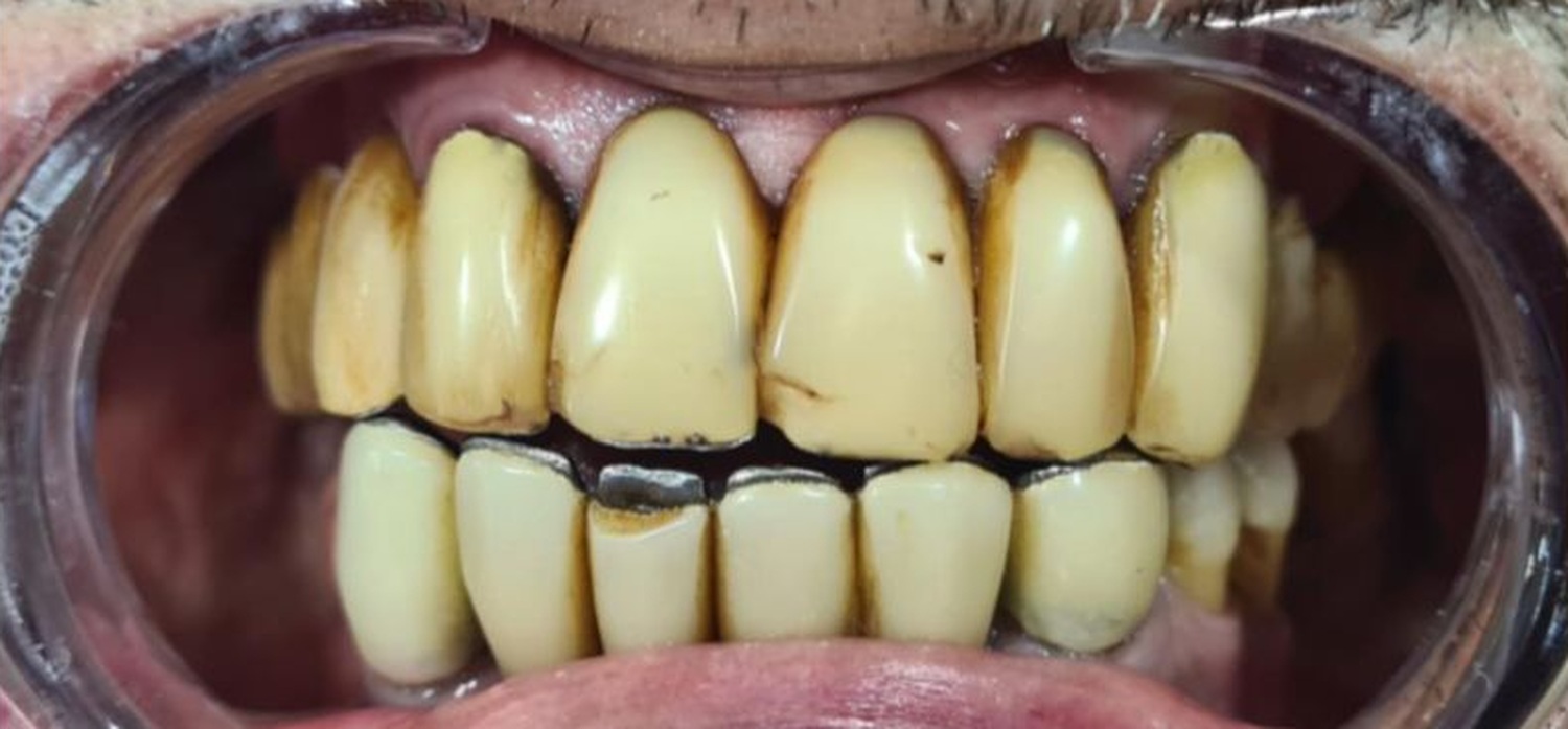 Before treatment at İ-Klinik