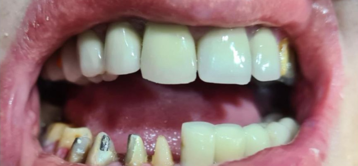 Before treatment at İ-Klinik